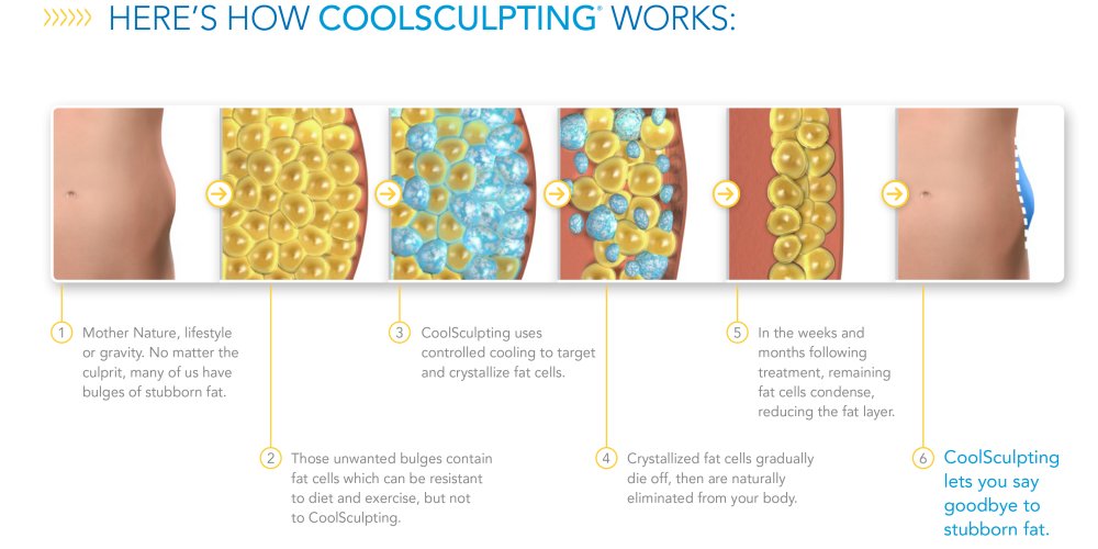 how-coolsculpting-works